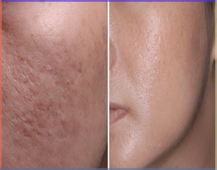 How Long Does It Really Take to See Results from Acne Scar Treatments?